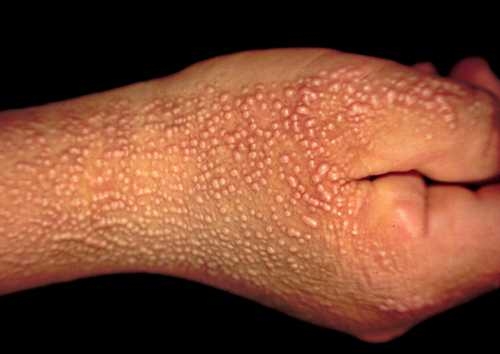 手部皮肤真菌感染图片_手部皮肤真菌感染